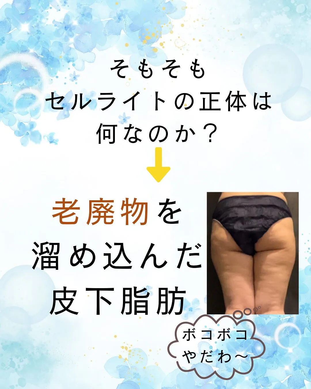 セルライトを溜め込む食生活があることご存知ですか?